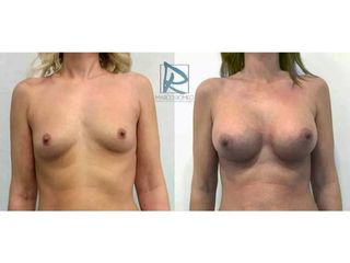 Antes y después Aumento de pecho