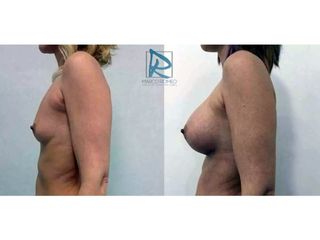 Antes y después Aumento de pecho