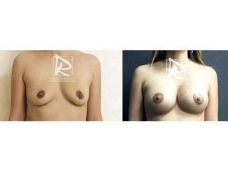 Antes y después Aumento de pecho