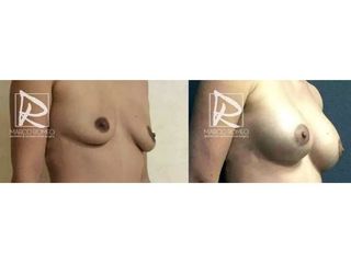 Antes y después Aumento de pecho
