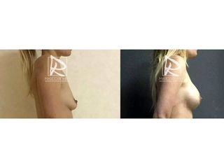 Antes y después Aumento de pecho