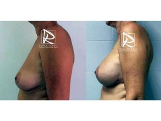 Antes y después Aumento de pecho