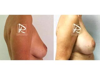 Antes y después Aumento de pecho