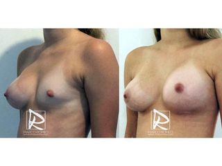 Antes y después Aumento de pecho