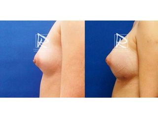 Antes y después Aumento de pecho