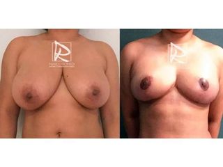Antes y después Reducción de mamas