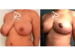 Antes y después Reducción de mamas