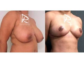 Antes y después Reducción de mamas