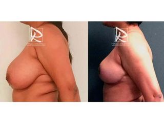 Antes y después Reducción de mamas