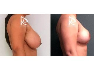 Antes y después Reducción de mamas