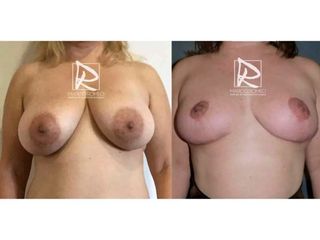 Antes y después Reducción de mamas