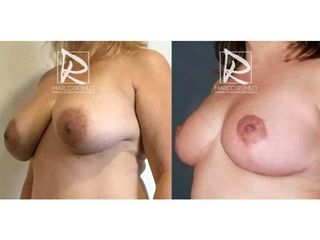 Antes y después Reducción de mamas