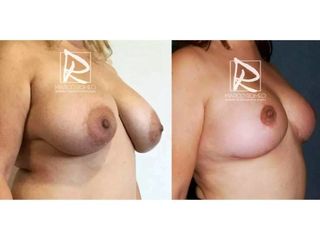Antes y después Reducción de mamas