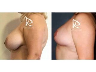 Antes y después Reducción de mamas