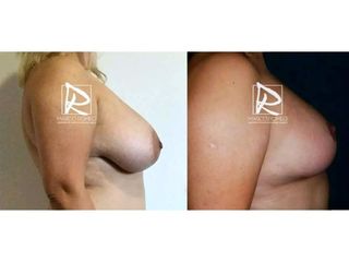 Antes y después Reducción de mamas