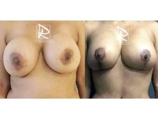 Antes y después Mastopexia