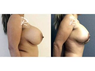 Antes y después Mastopexia