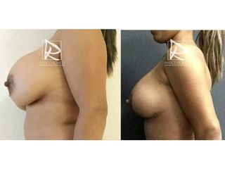 Antes y después Mastopexia