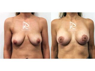 Antes y después Mastopexia