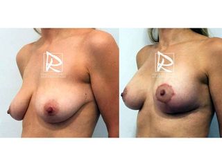 Antes y después Mastopexia