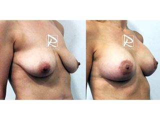 Antes y después Mastopexia
