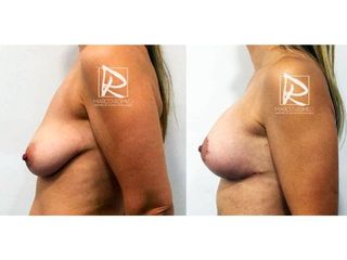 Antes y después Mastopexia