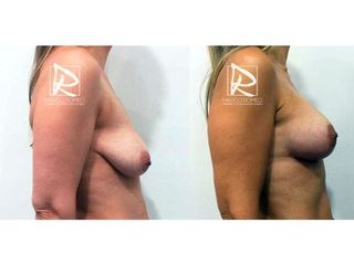 Antes y después Mastopexia