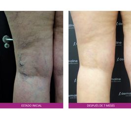 Antes y después Tratamiento varices