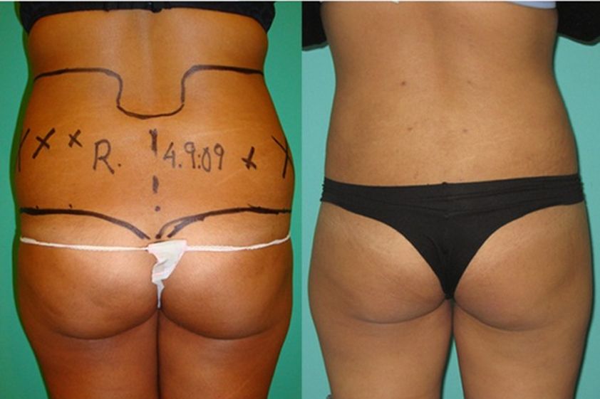 Hidrolipoclasia antes y después - 500746
