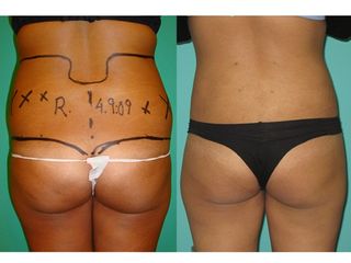 Antes y después Hidrolipoclasia