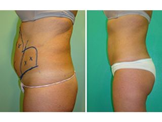 Antes y después Hidrolipoclasia