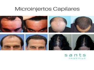Antes y después Microinjertos