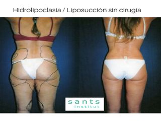 Antes y después Liposucción