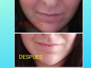 Antes y después Relleno de labios con ácido hialurónico