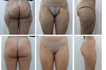 Hidrolipoclasia - Sants Institut