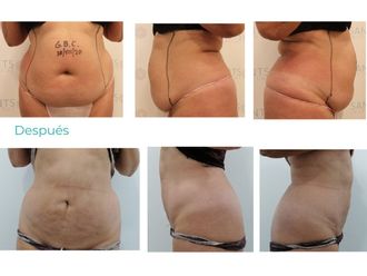 Hidrolipoclasia antes y después - 815619