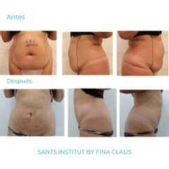 Hidrolipoclasia - Sants Institut