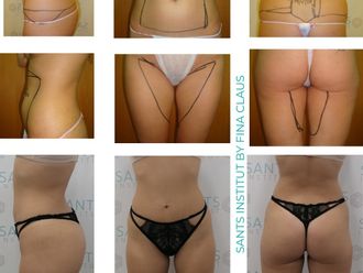 Hidrolipoclasia antes y después - 815620