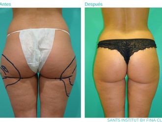Hidrolipoclasia antes y después - 815621