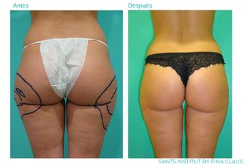 Hidrolipoclasia - Sants Institut