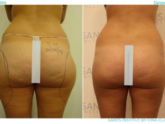 Hidrolipoclasia antes y después - 815622