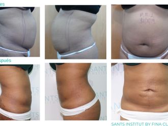Hidrolipoclasia antes y después - 815623