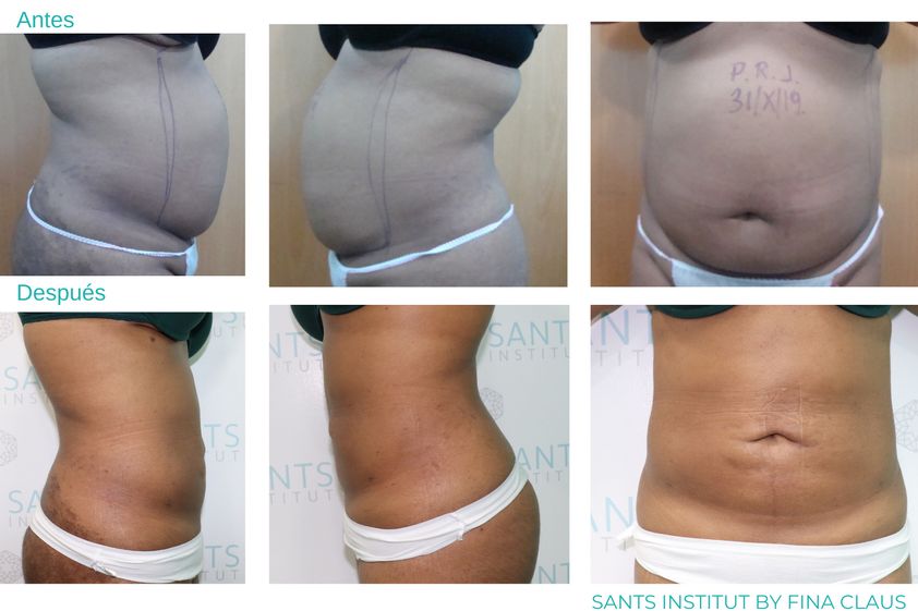 Hidrolipoclasia antes y después - 815623