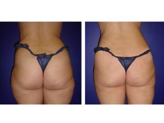 Lipoescultura