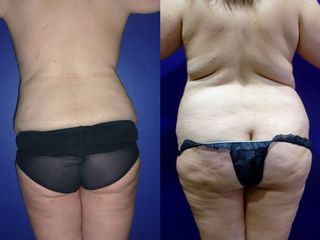 Lipoescultura Antes y Después