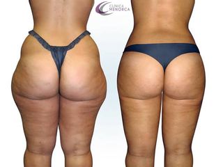 Antes y despues de Lipoescultura