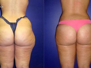 Antes y despues de lipoescultura