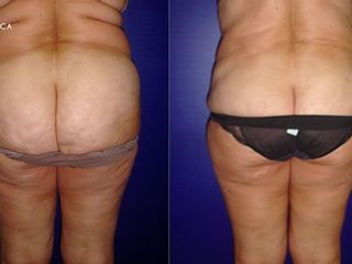 Antes y despues de lipoescultura