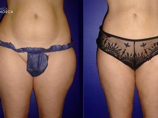 Antes y despues de lipoescultura