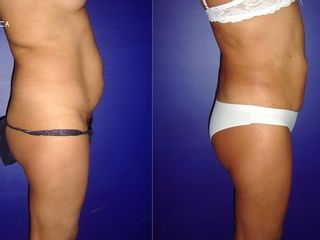 Antes y despues de lipoescultura